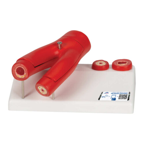 Modelo de arteriosclerosis con sección transversa de la arteria, de 2 piezas