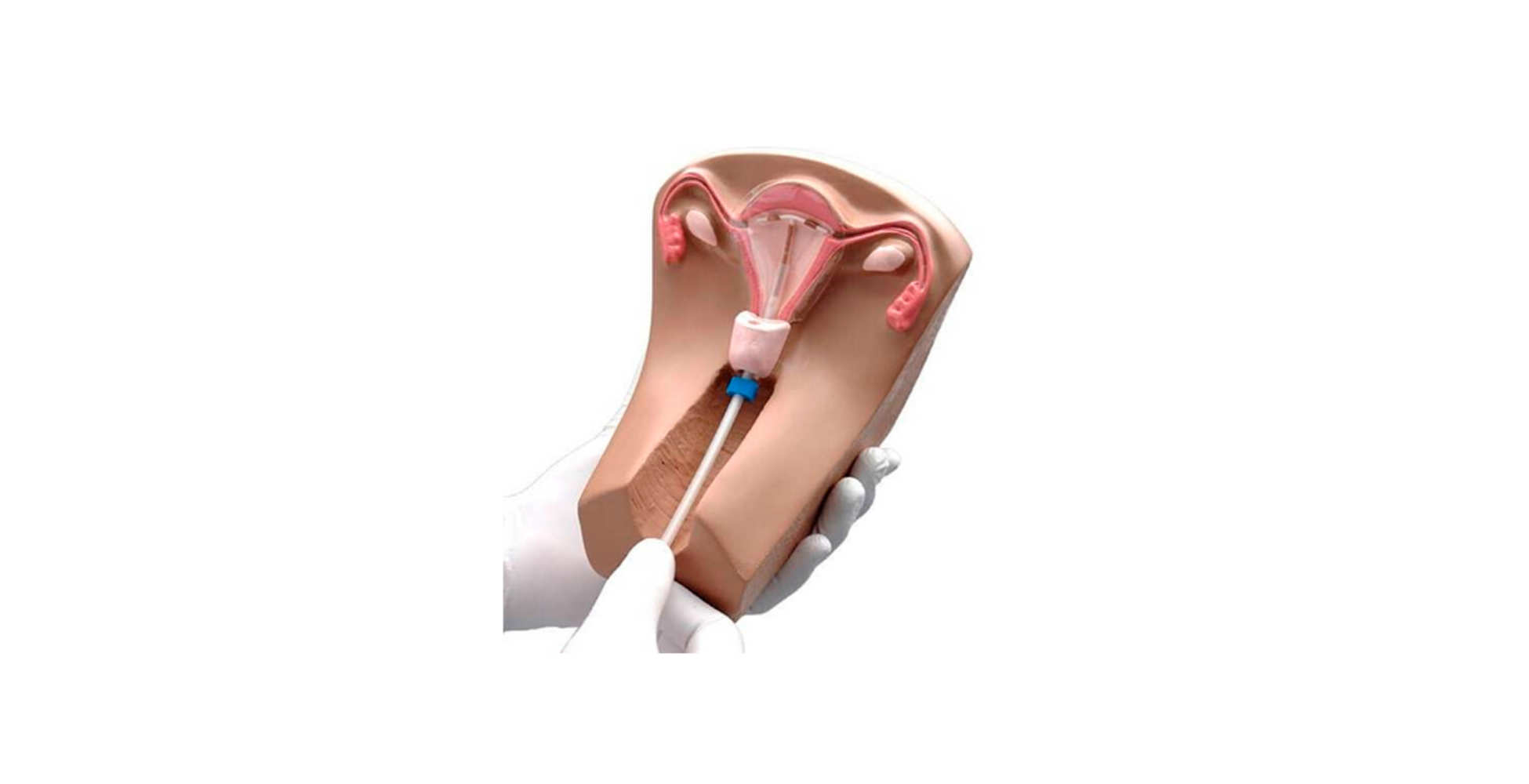 Modelo Inserción de DIU III Tellyes