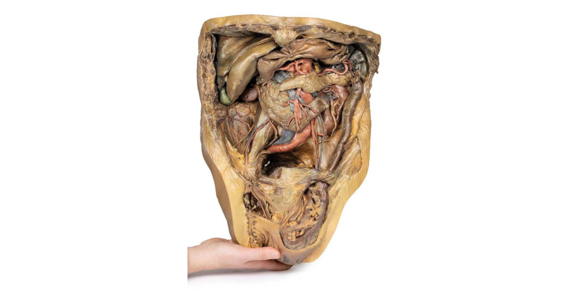 Abdomen con Hernia Inguinal tres marca erler zimmer