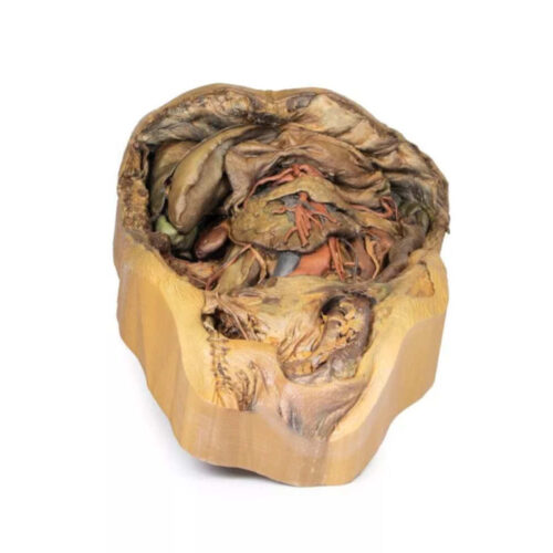 Abdomen con Hernia Inguinal uno marca erler zimmer