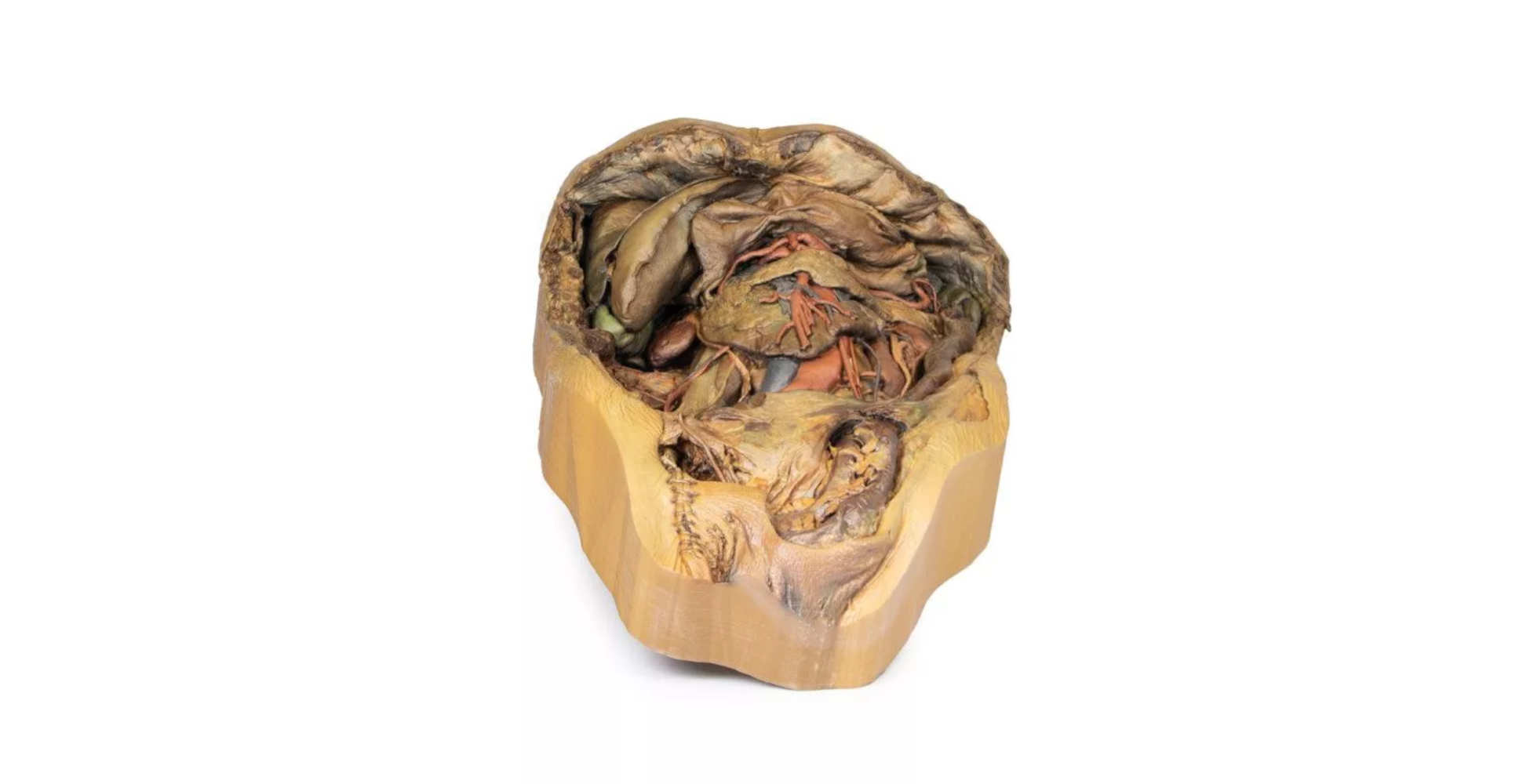 Abdomen con Hernia Inguinal uno marca erler zimmer