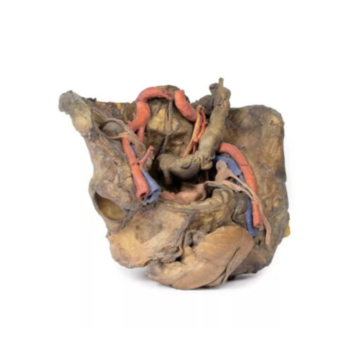 Disección Profunda de Pelvis Femenina uno marca erler zimmer