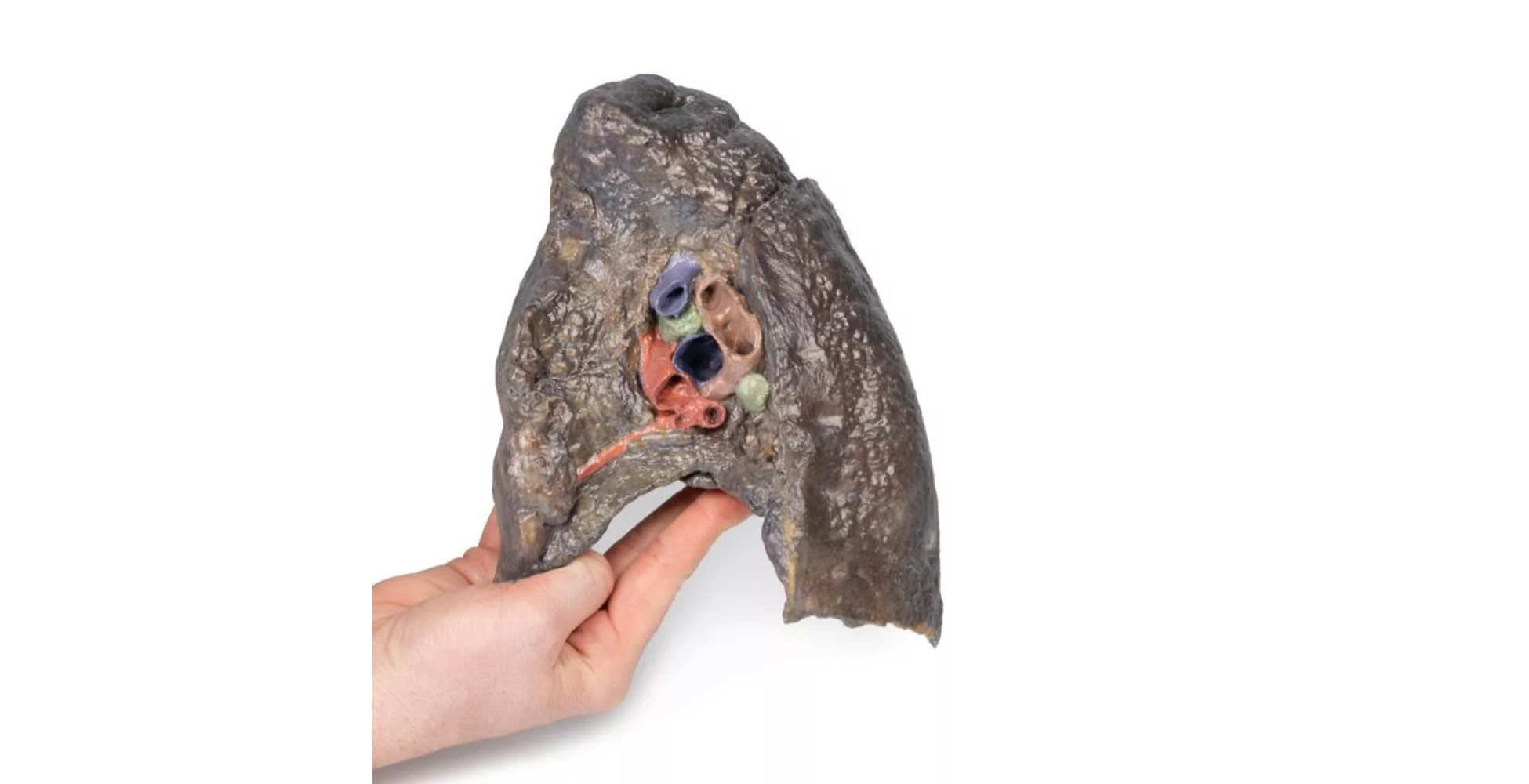 Hilio del Pulmón Derecho dos marca erler zimmer