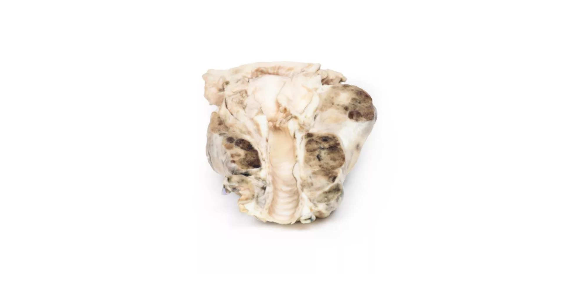 Bocio Multinodular marca erler zimmer