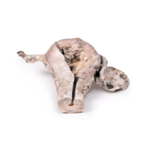 Carcinoma de endometrio para estudio de patologia ginecologica uno marca erler zimmer