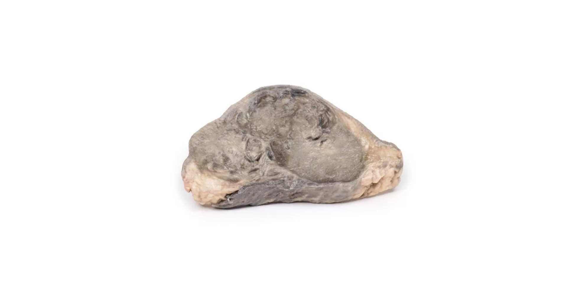 Carcinoma de Mama marca erler zimmer