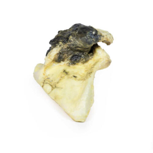 condrosarcoma de la escapula uno marca erler zimmer