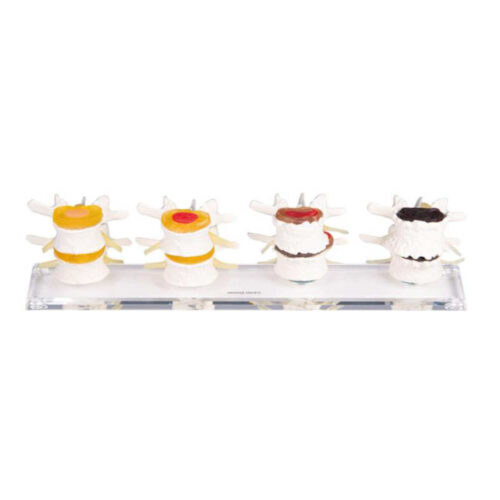 Etapas de la degeneración discal marca erler zimmer