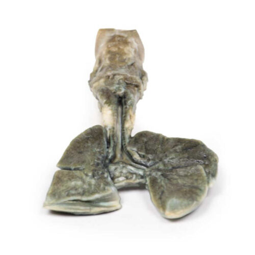 Fístula Traqueoesofágica y Atresia Esofágica marca erler zimmer