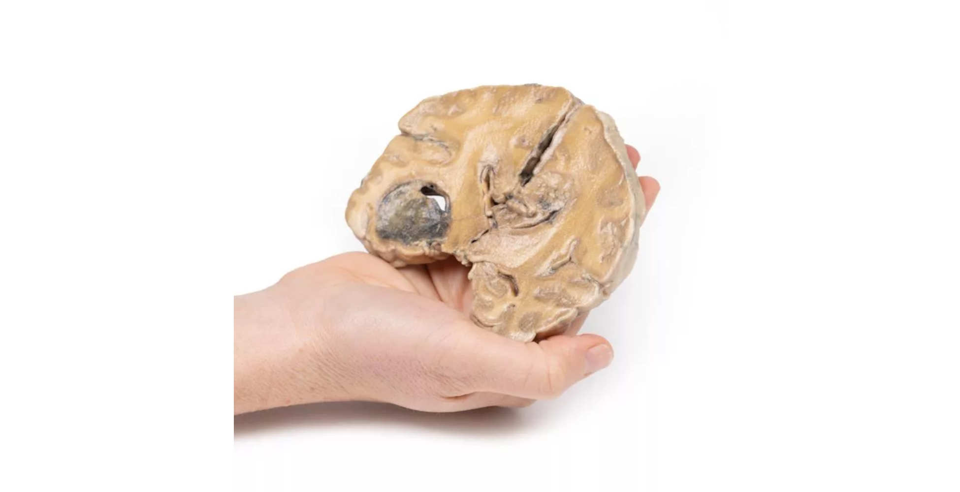 Glioblastoma Multiforme dos marca erler zimmer