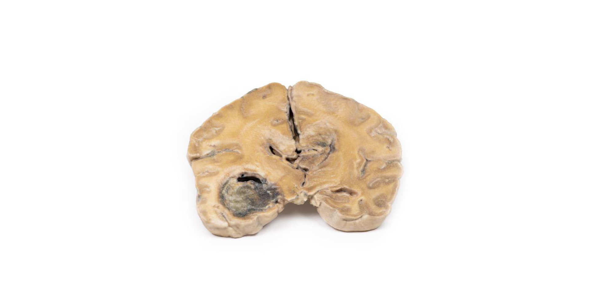 Glioblastoma Multiforme uno marca erler zimmer