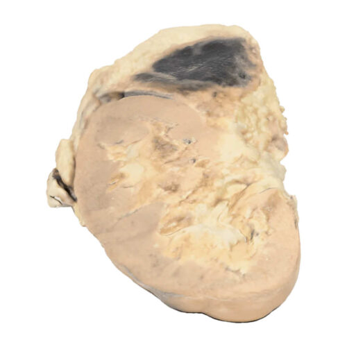 Hemorragia Suprarrenal marca erler zimmer