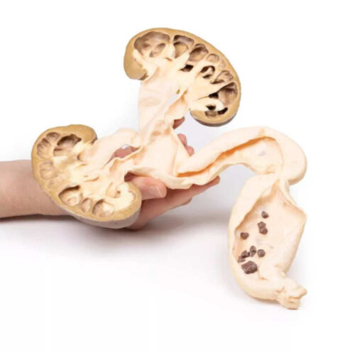 Hidroureter para Hidronefrosis uno marca erler zimmer