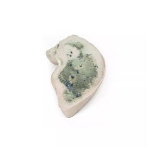 Hígado Graso (Esteatosis Hepática) marca erler zimmer