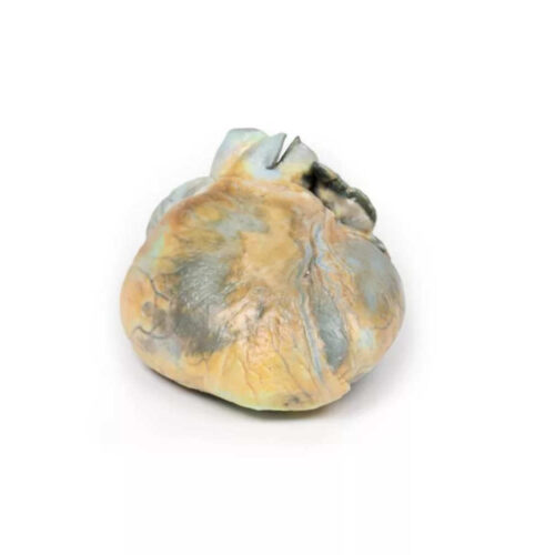 Hipertrofia Ventricular Derecha uno marca erler zimmer