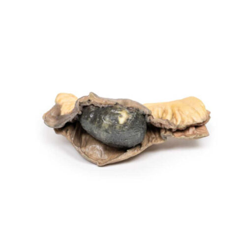 Íleo Biliar marca erler zimmer