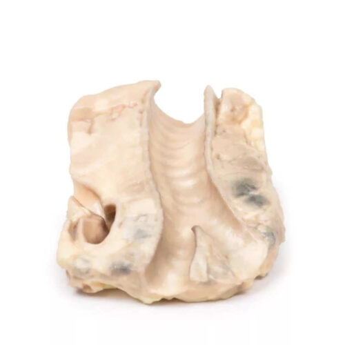 Linfoma de Hodgkin en Tráquea uno marca erler zimmer