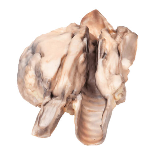 Linfoma de Tiroides uno marca erler zimmer