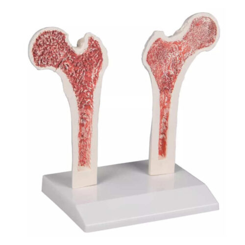 Modelo Anatómico Osteoporosis del fémur marca erler zimmer