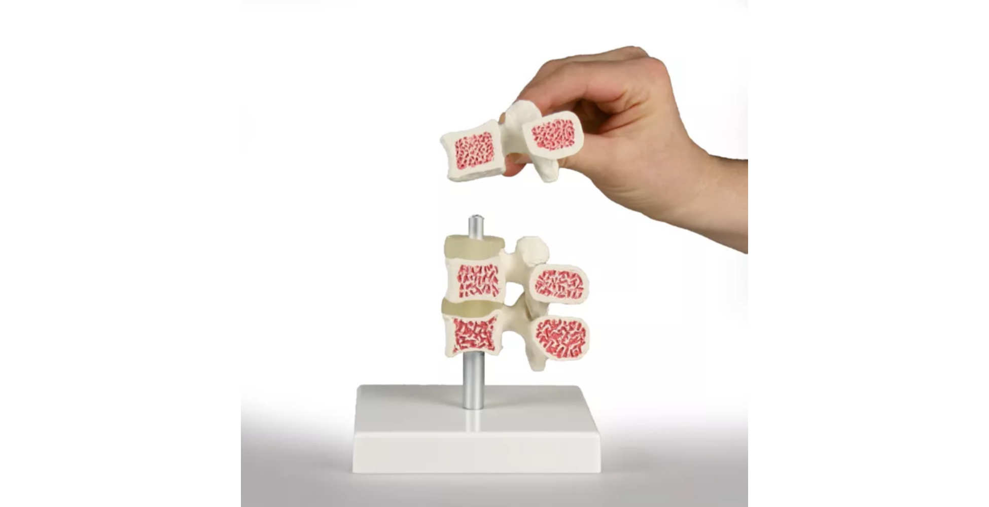 Modelo de evolución de la osteoporosis en la columna lumbar dos marca erler zimmer