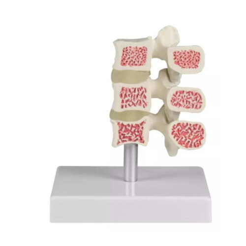 Modelo de evolución de la osteoporosis en la columna lumbar uno marca erler zimmer