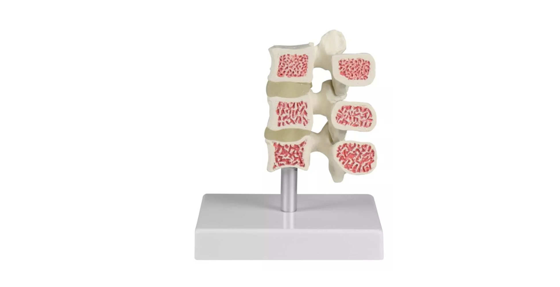 Modelo de evolución de la osteoporosis en la columna lumbar uno marca erler zimmer