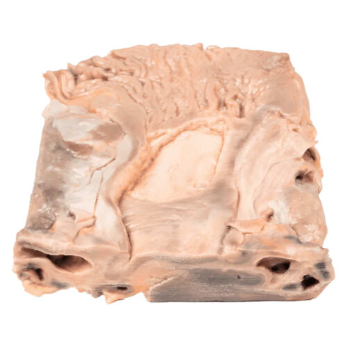 Úlcera Gástrica Crónica marca erler zimmer