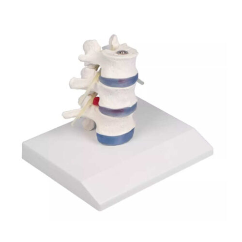 Vértebras lumbares con hernia discal intervertebral y soporte marca erler zimmer