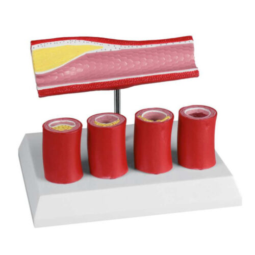 Arteria con 4 secciones arteriales marca erler zimmer