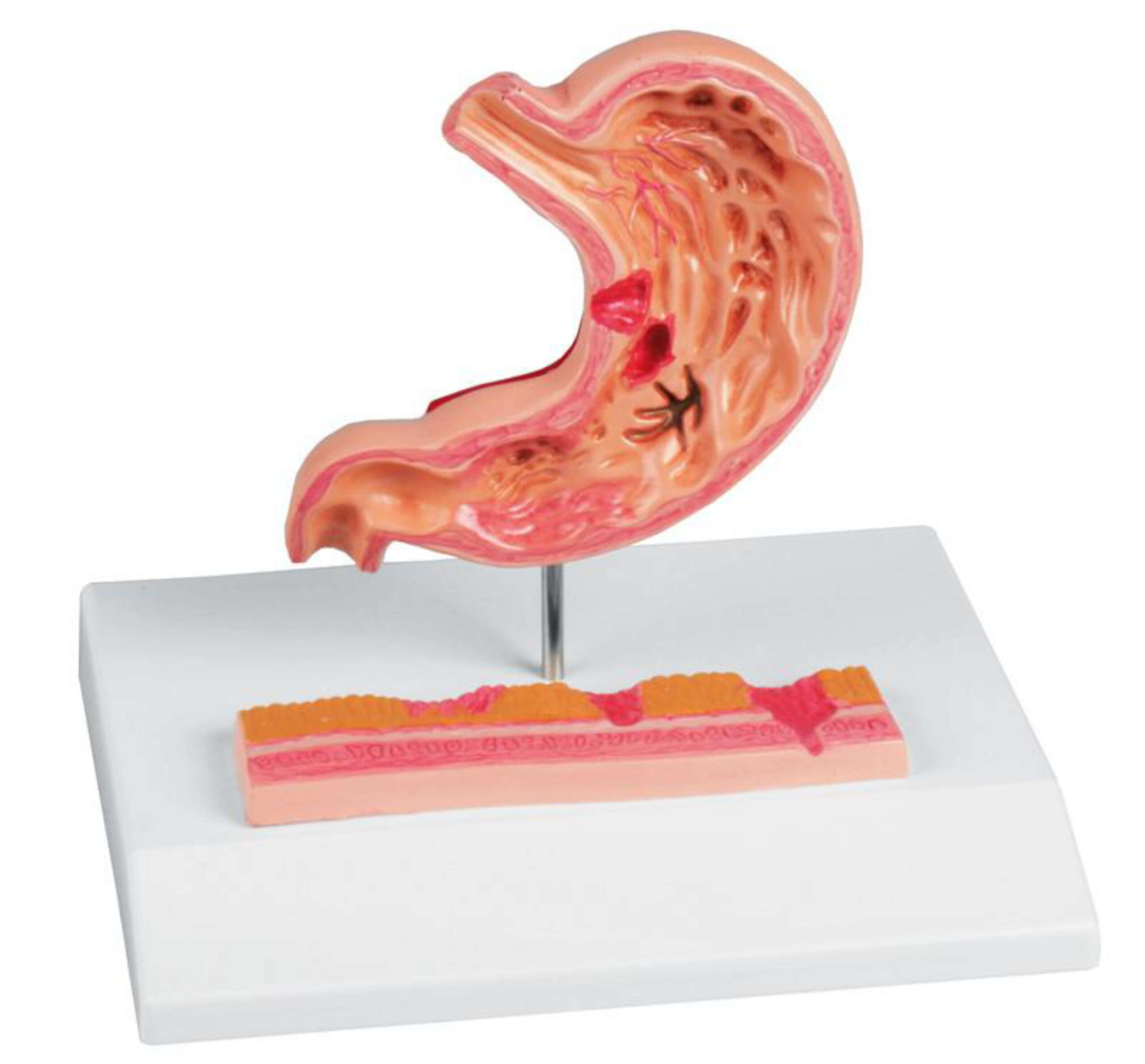 Estomago con ulceras marca erler zimmer