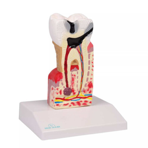 Modelo de caries dental, 10 veces el tamaño real marca erler zimmer