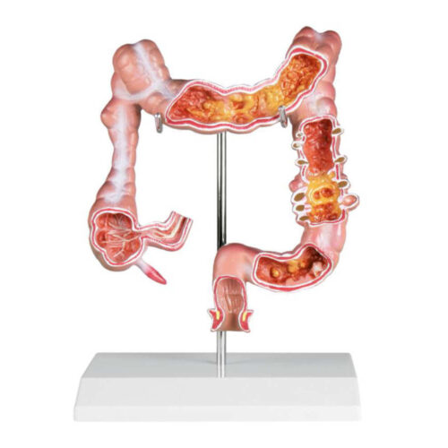 Modelo de colon con enfermedades marca erler zimmer
