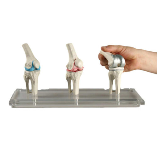Modelo de implante de rodilla marca erler zimmer