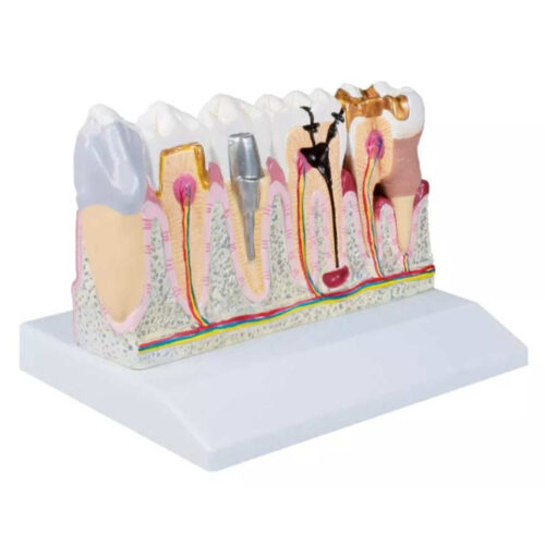 Modelo dental, 4 veces el tamaño real marca erler zimmer